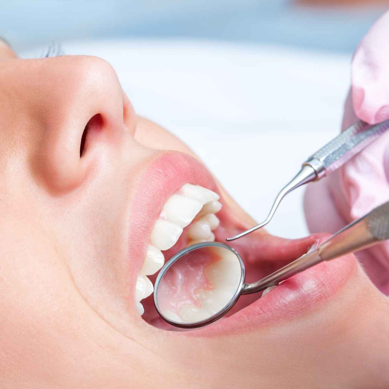 Oral Cancer Screenings