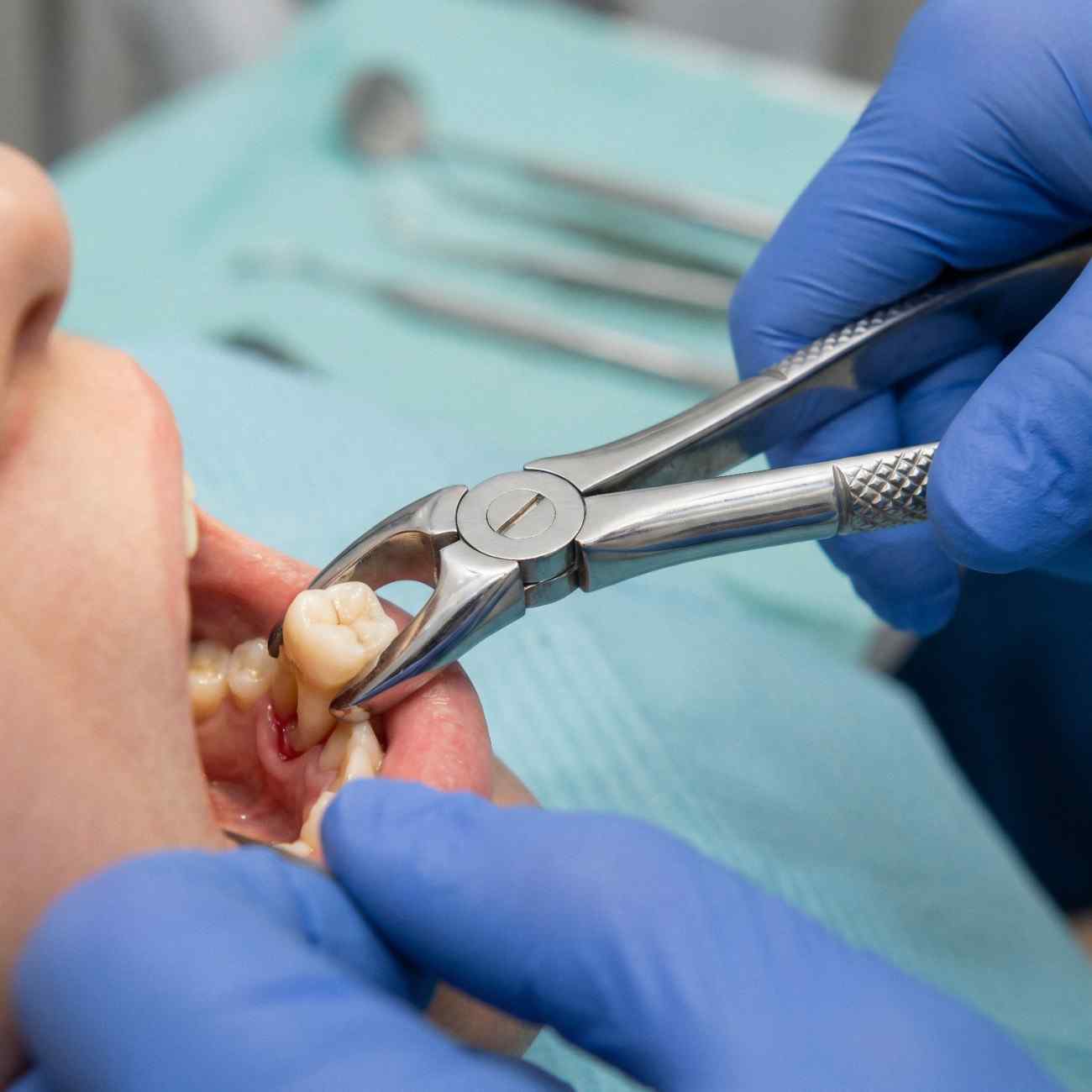 Tooth Extractions