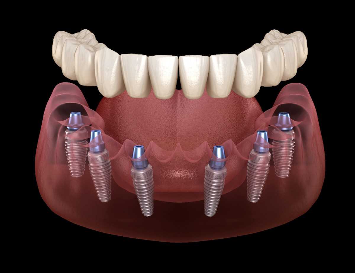 All-on-X dental implants and smile restoration