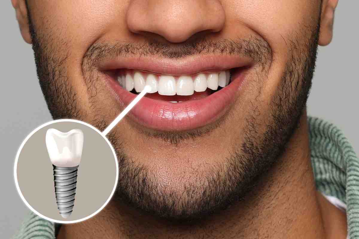 Why choose dental implants in Riverbank, California