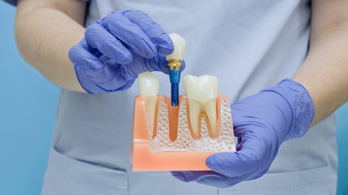 Why choose dental implants in Patterson, California