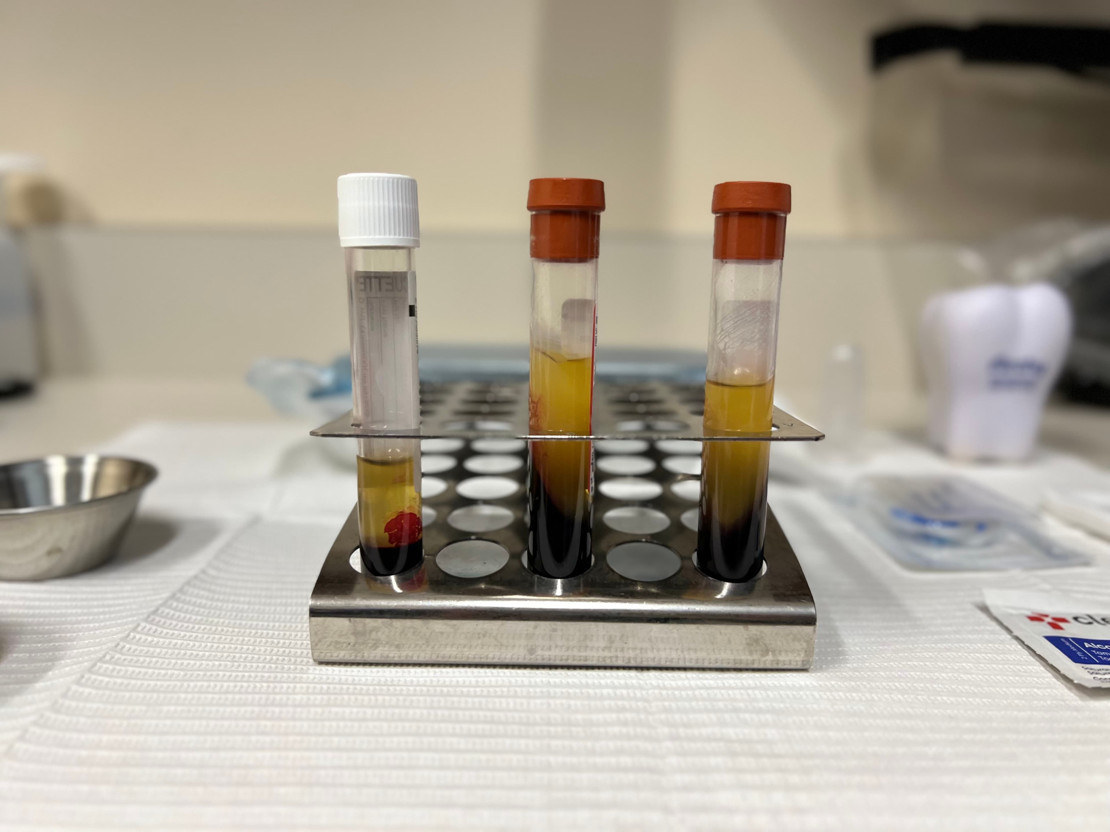 Platelet Rich Fibrin Therapy Process