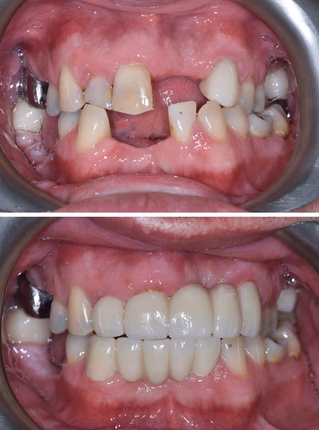 Dental Implants Before & After