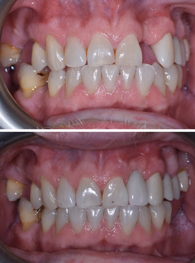 Cosmetic Dentistry Before & After