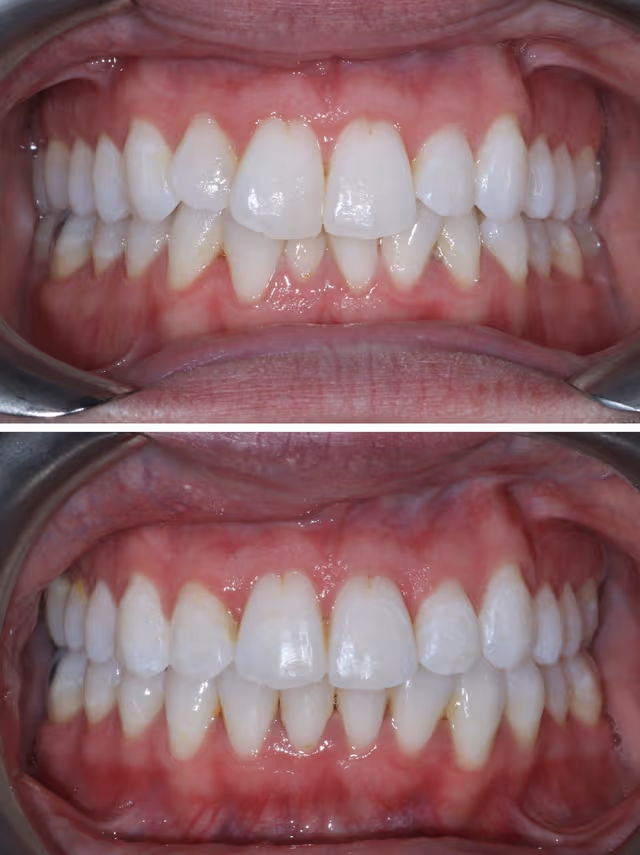 Cosmetic Dentistry Before & After