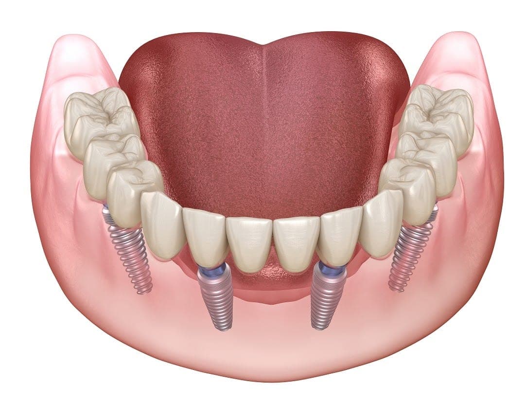 Dental Implants - Spreckels Park Dental