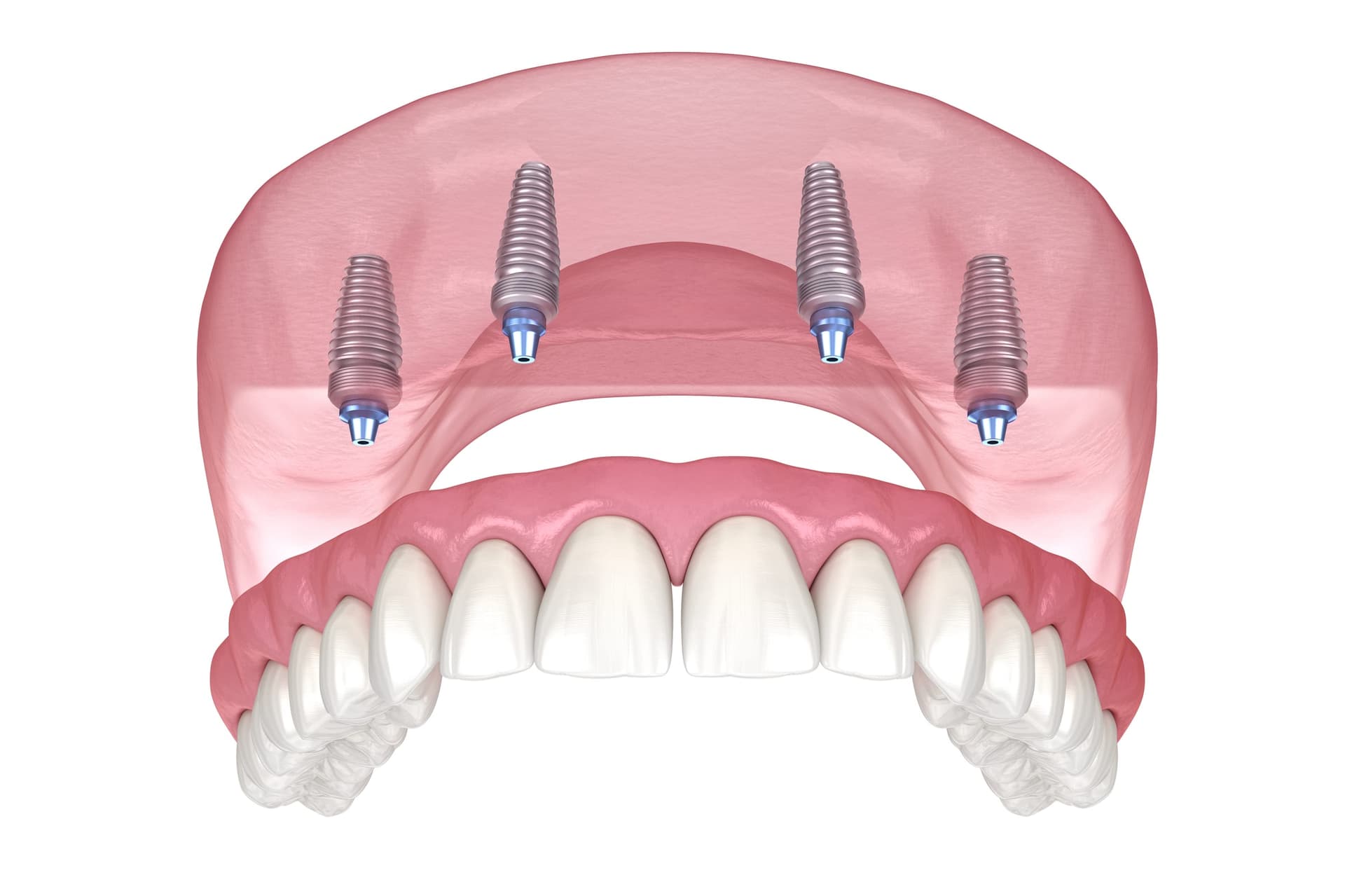 Implant Denture - Spreckels Park Dental