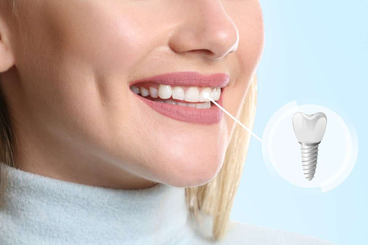 Why choose dental implants in Stockton, California
