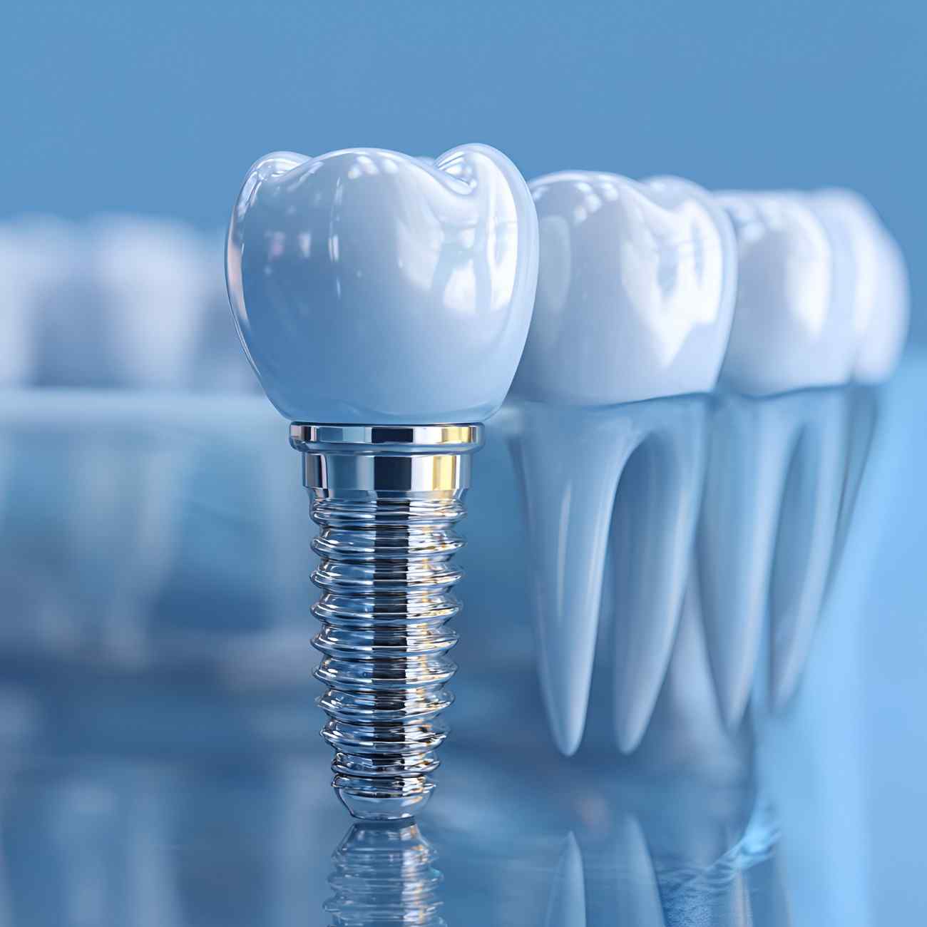 Benefits of dental implants in Salida, California