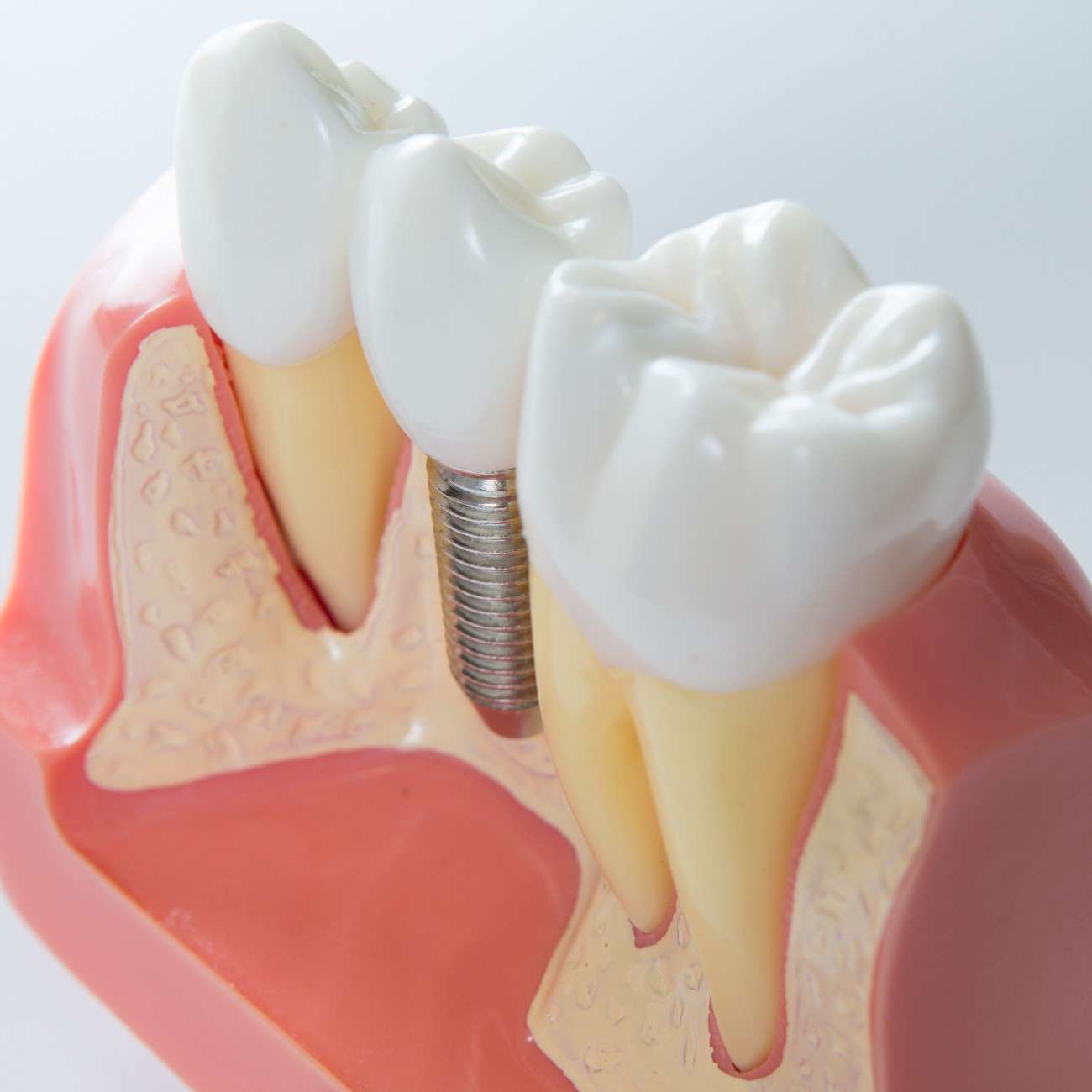 Benefits of dental implants in Lathrop, California