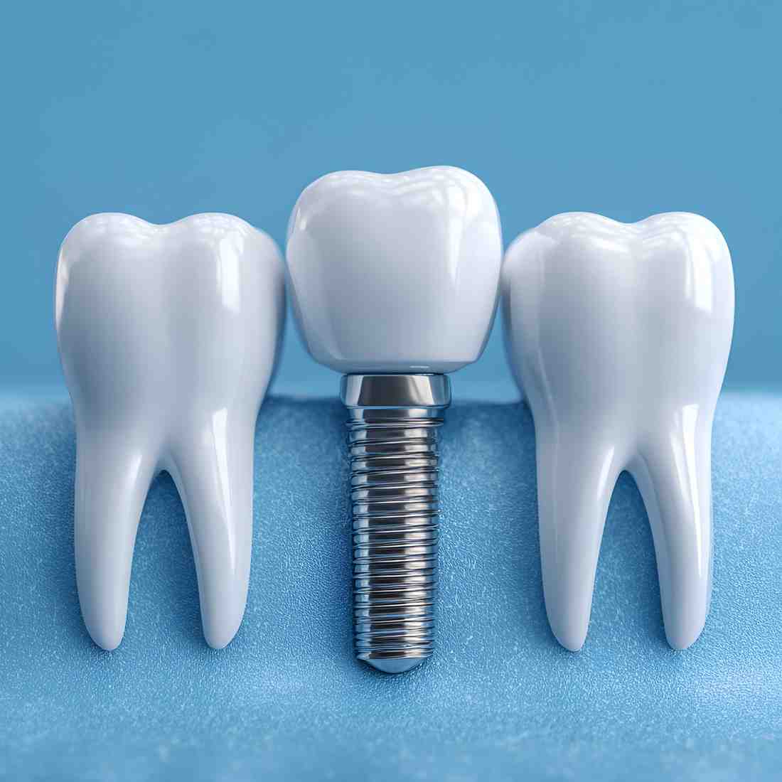 Benefits of dental implants in Ripon, California