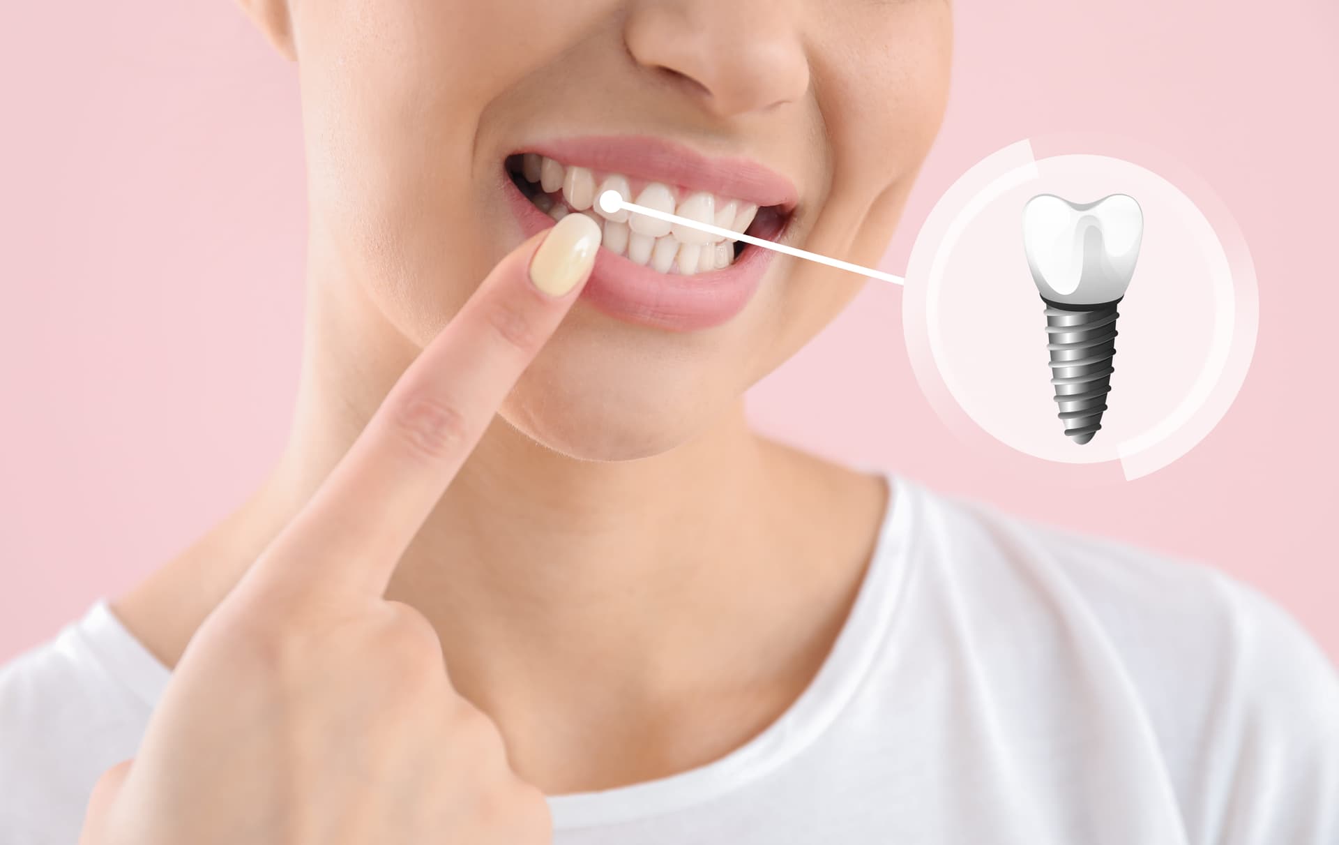 Preparing for Dental Implant Surgery: Tips for a Smooth Procedure
