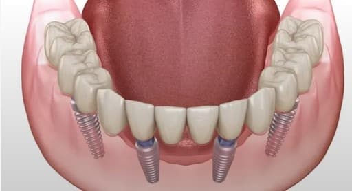 How Many Implants Can You Get at One Time?